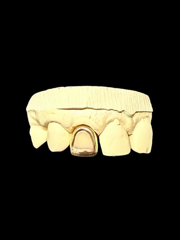 Open Face Gold Crowns