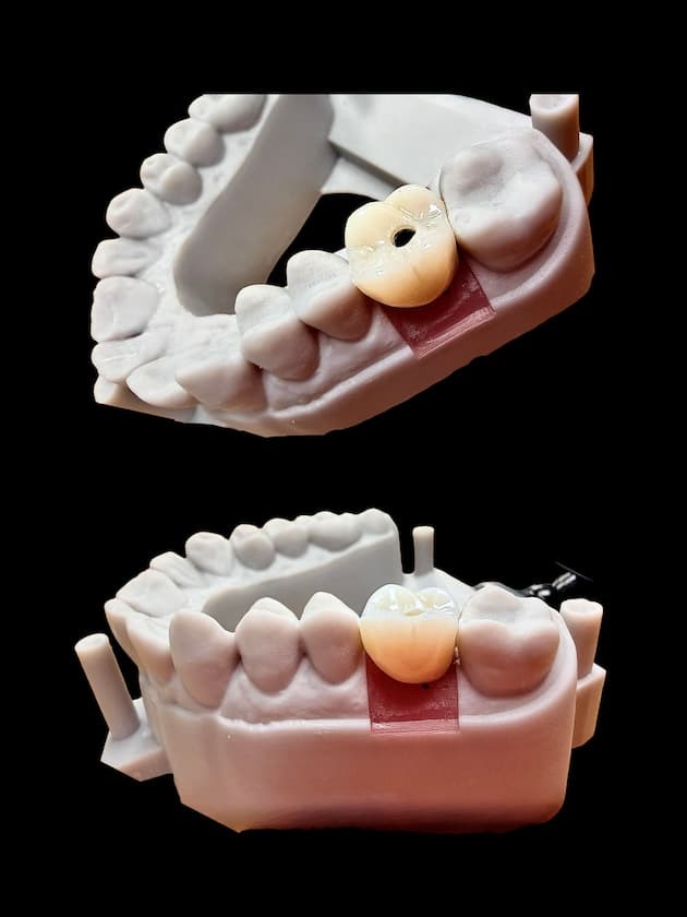 Screw Retained Custom