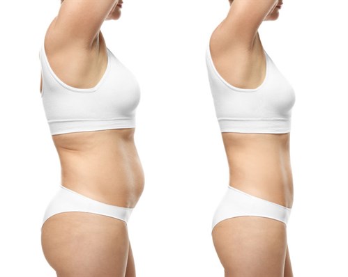 Women before and after liposuction
