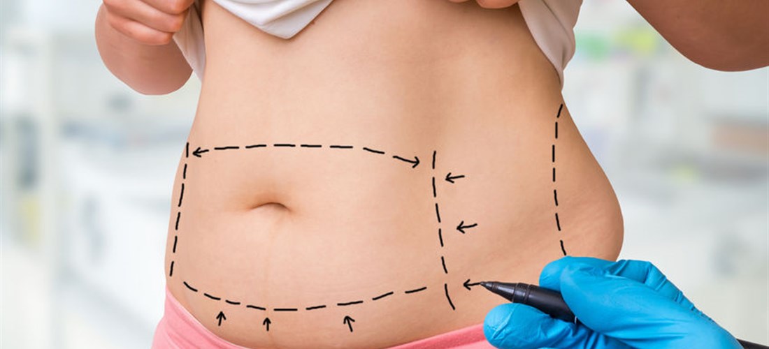 tummy tuck Archives - ICLS Dermatology & Plastic Surgery