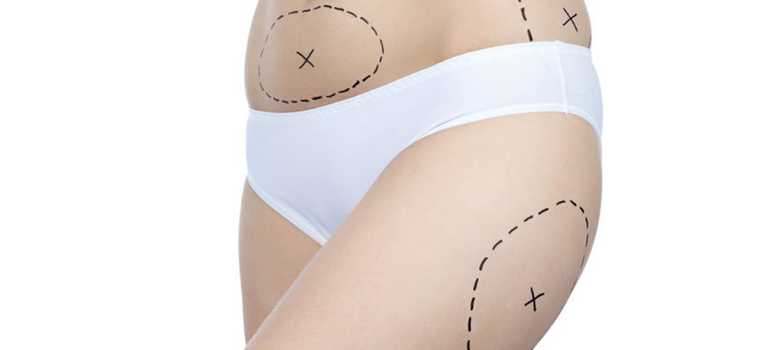 What liposuction recovery supplies should I gather before my surgery?