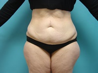 Dr. Serra Surgical Before & After